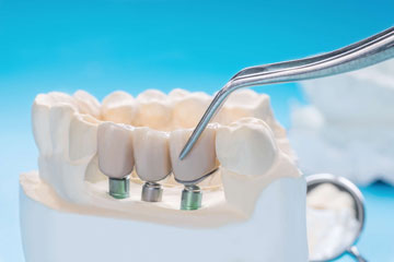 Dental implants from Haydn G. Jones, a trusted dentist in Myers Park/Dilworth.