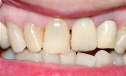 Teeth before replacing existing bridge with all-ceramic version and one all-crown