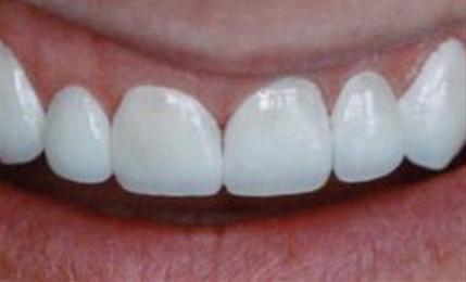 Teeth before six porcelain veneers