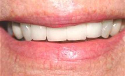 Teeth after replacing existing bridge with all-ceramic version and one all-crown