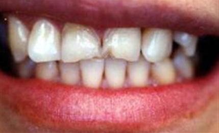 Teeth after eight porcelain veneers