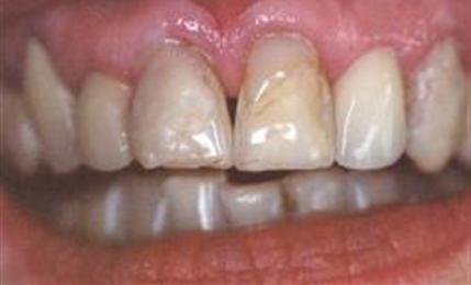 Teeth before being fitted with combination veneers and all-ceramic and conventional crowns