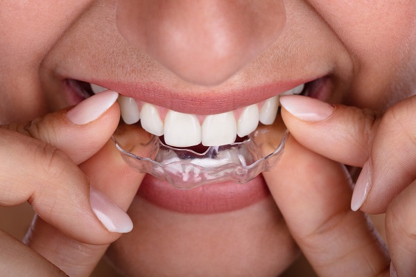 Invisalign for teeth straightening on East Boulevard in the Myers Park area in Charlotte.