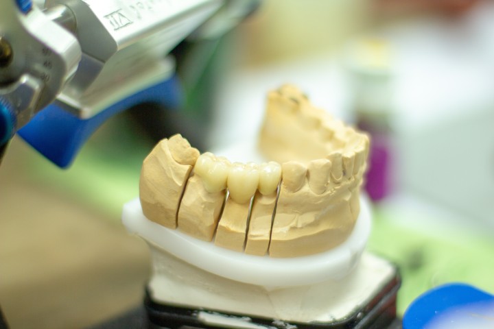 Dentist making ceramic crowns, Charlotte, NC